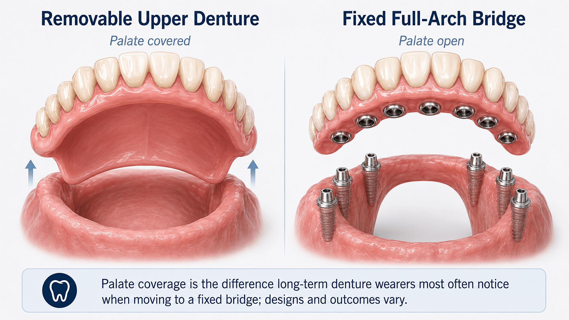 Illustration comparing a removable upper denture covering the palate with a fixed full-arch bridge that leaves the palate open.