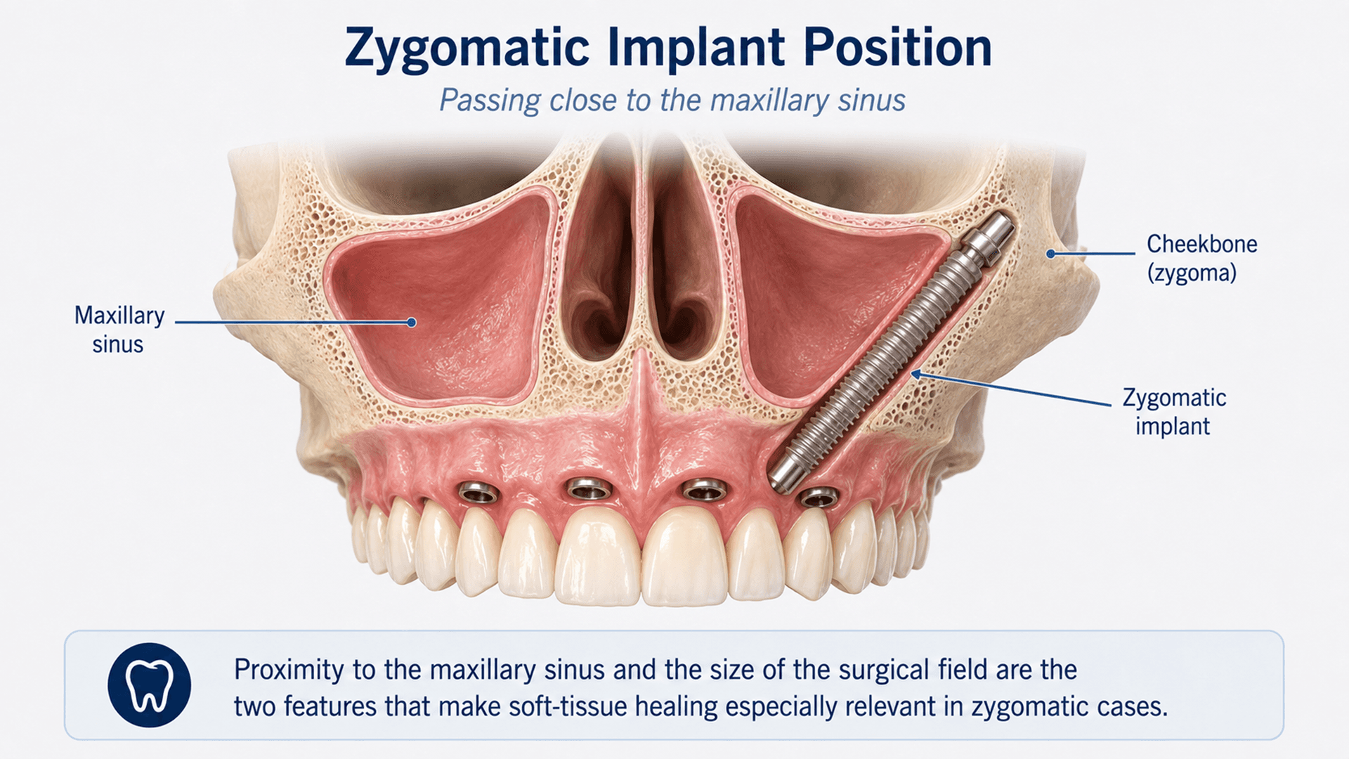Illustration showing the position of a zygomatic implant passing close to the maxillary sinus on its route to the cheekbone.