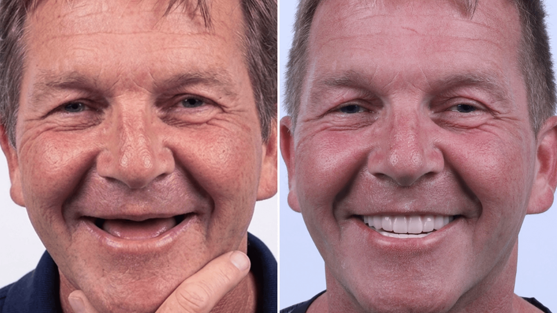Consented before & after patient case — awaiting clinic imagery with documented consent