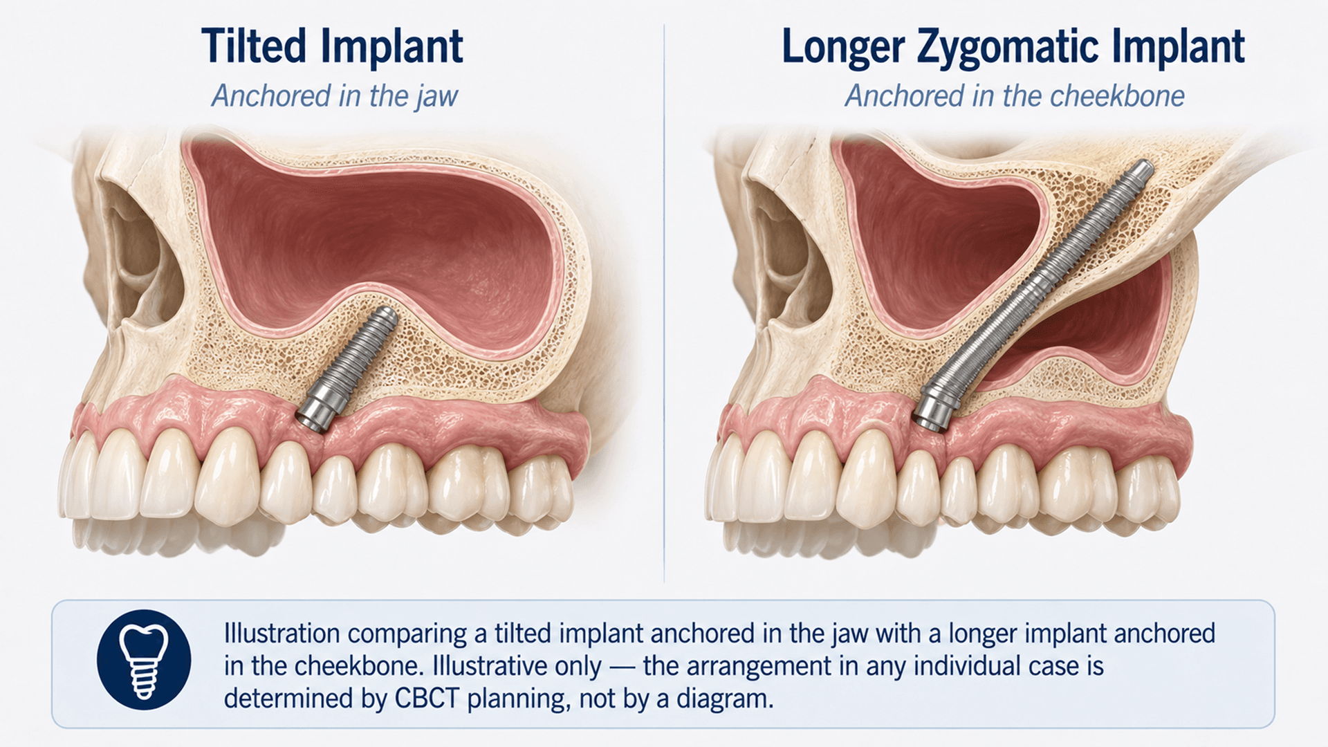 Illustration comparing a tilted implant anchored in the jaw with a longer implant anchored in the cheekbone