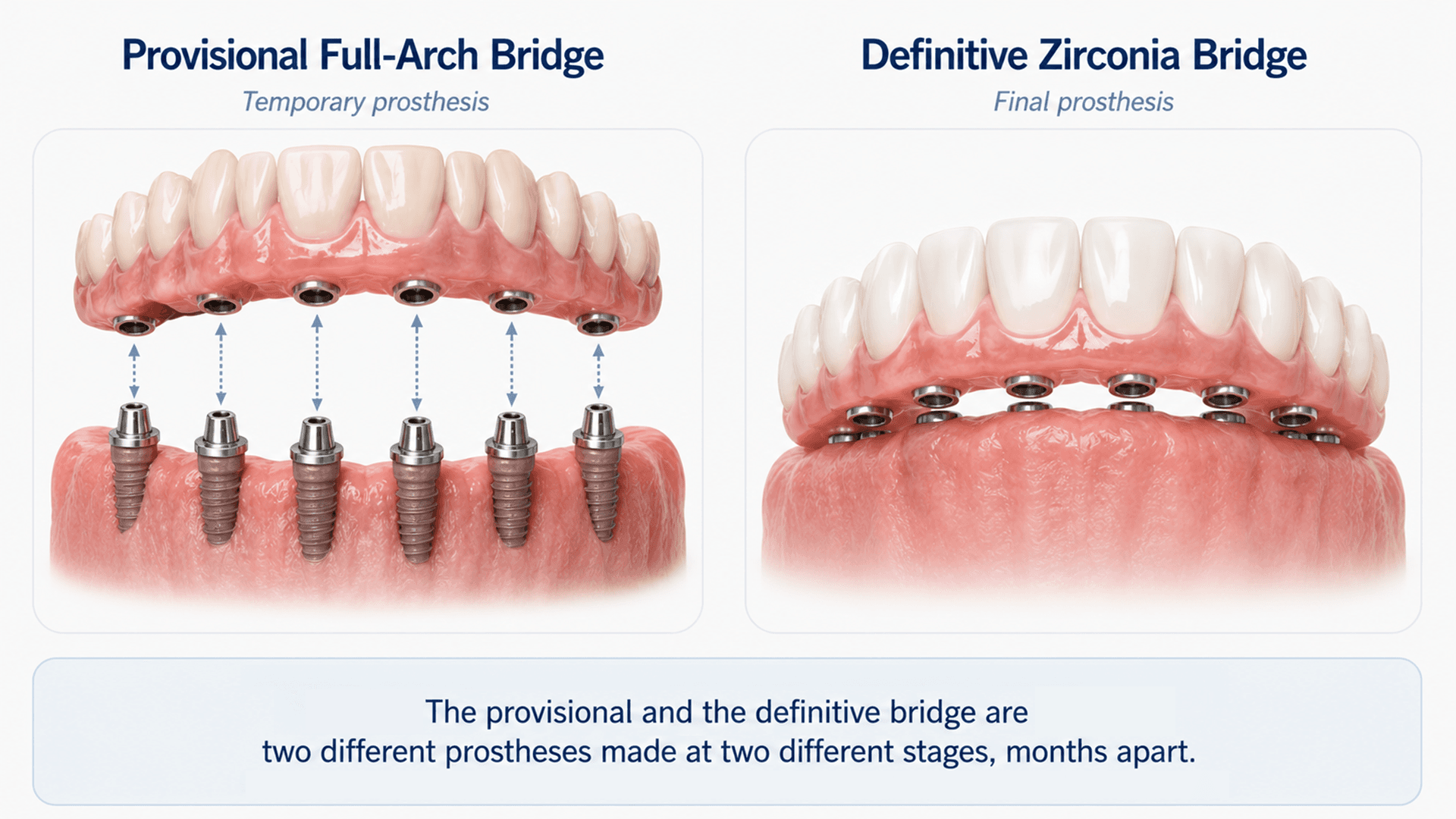 Illustration of a provisional full-arch bridge screwed onto implants alongside a definitive zirconia bridge