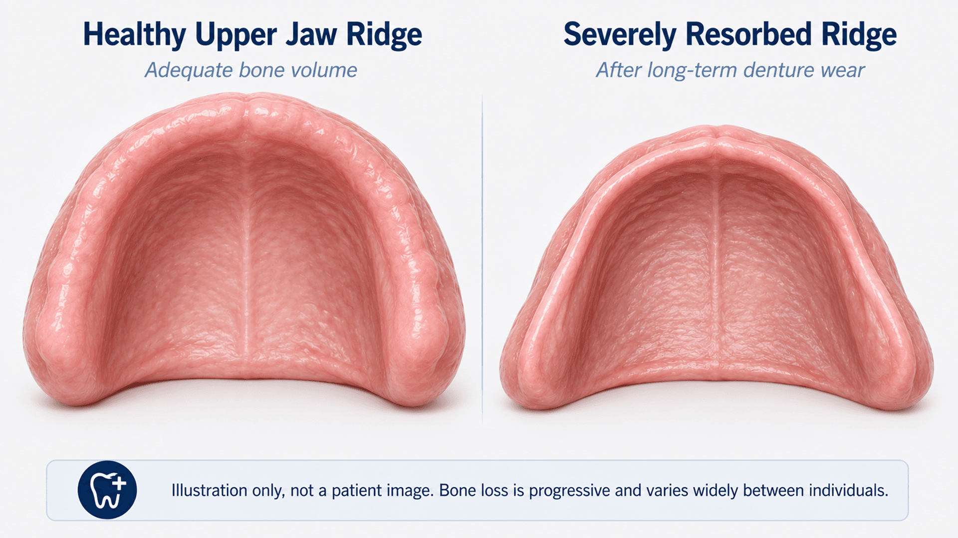 Illustration comparing a healthy upper jaw ridge with a severely resorbed ridge after long-term denture wear