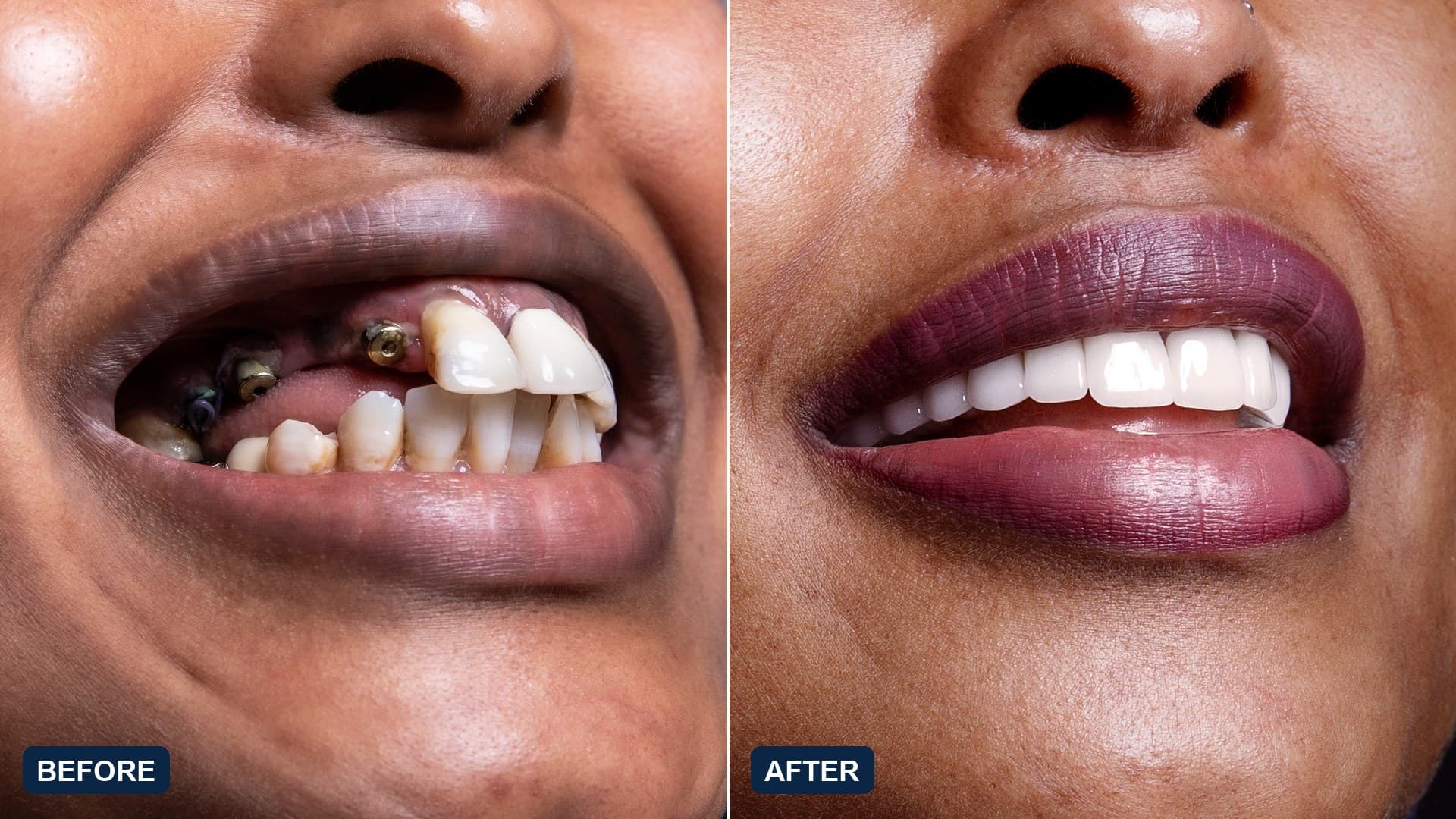 The same patient before and after full-arch treatment on zygomatic implants, photographed close up: on the left, failing upper teeth alongside exposed healing abutments; on the right, the fitted upper bridge in place. Published with the patient's written consent.