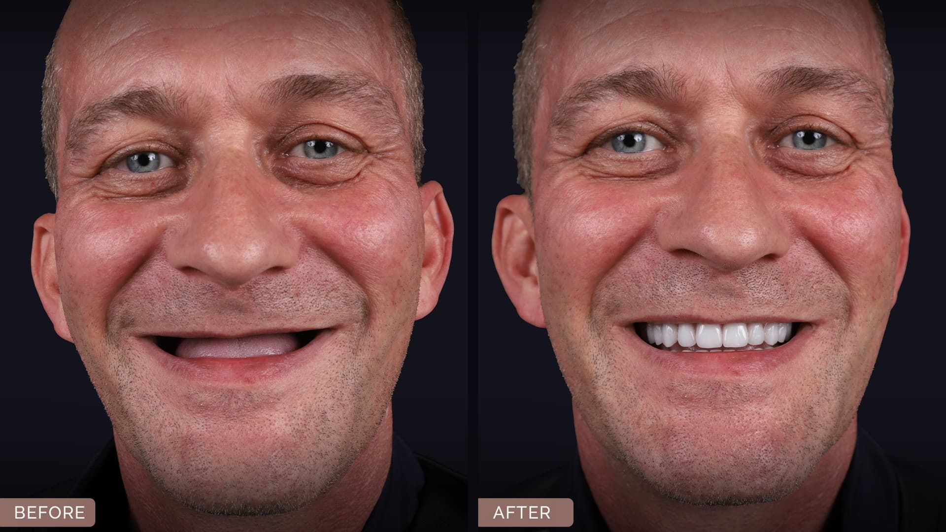 A patient of the treating clinic before and after full-arch treatment with zygomatic implants: on the left an upper jaw with no visible teeth, on the right a fixed upper bridge. Published with the patient's written consent.