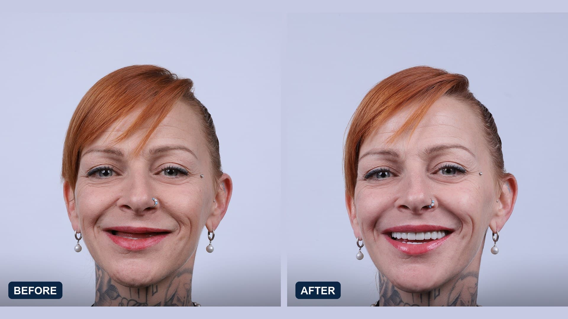 A second patient of the treating clinic before and after full-arch treatment on zygomatic implants, photographed from the same angle under the same lighting: the smile line and upper lip support differ between the two frames. Published with the patient's written consent.